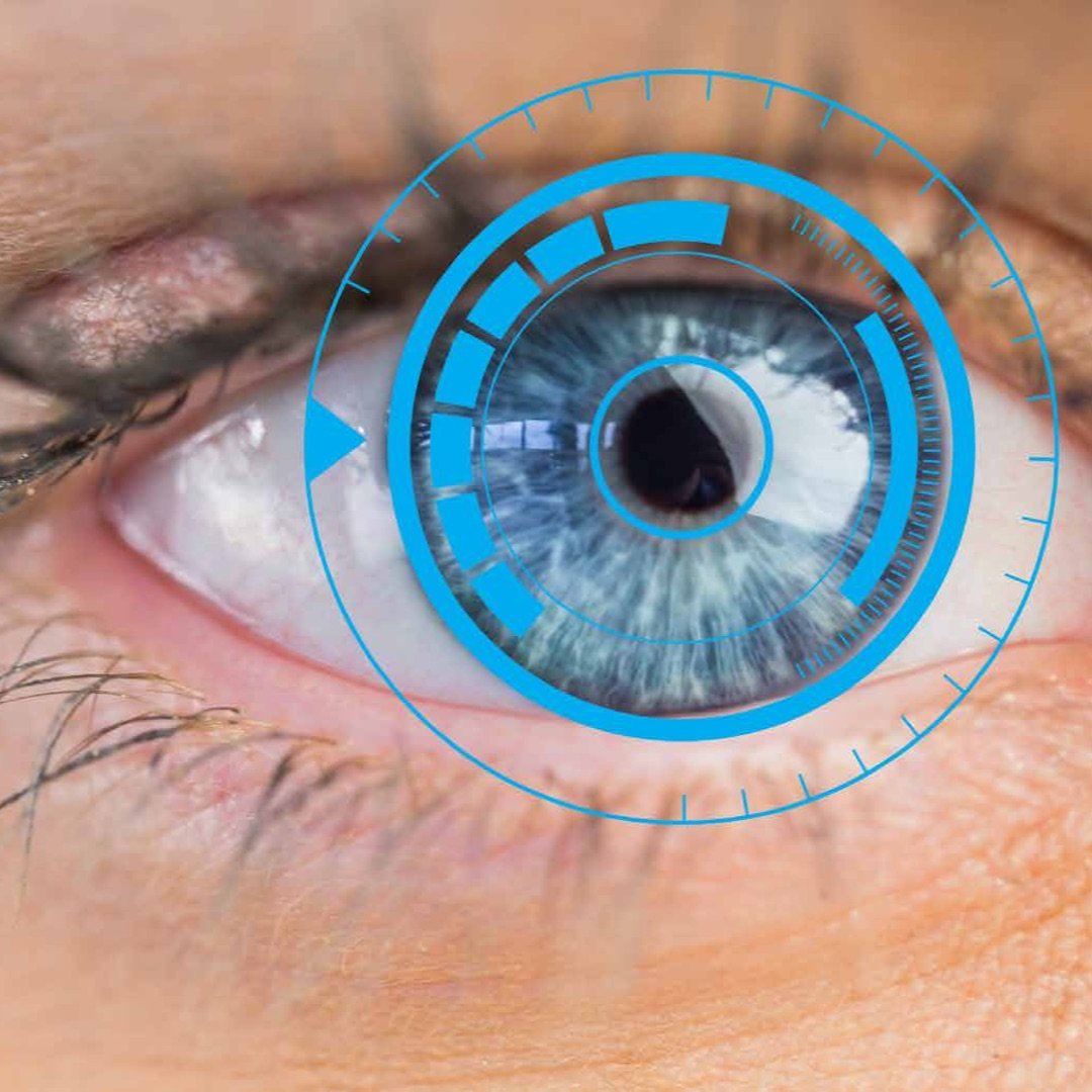 ¿Qué es la cirugía refractiva?
